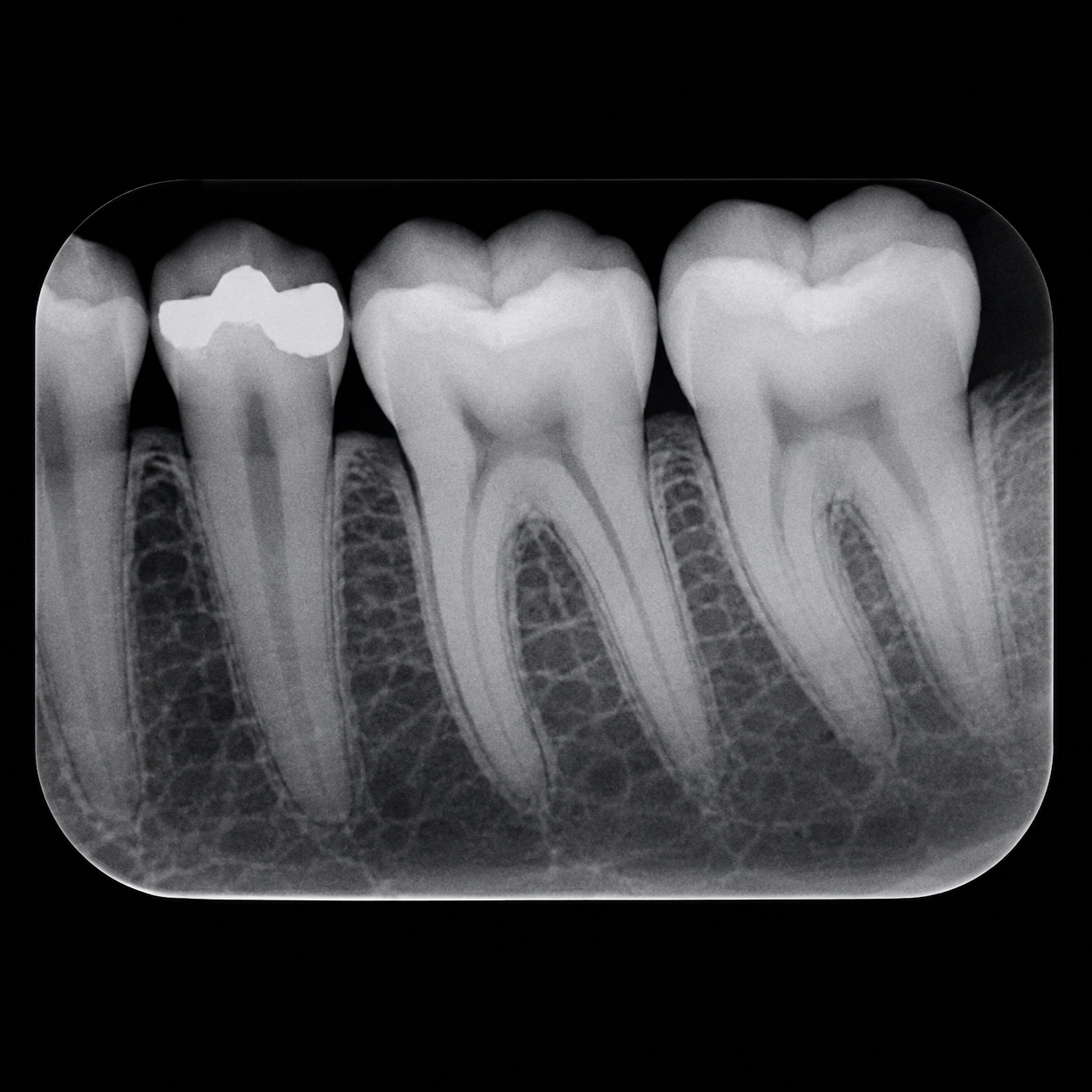 Dental X-Ray / IOPA X-Ray x