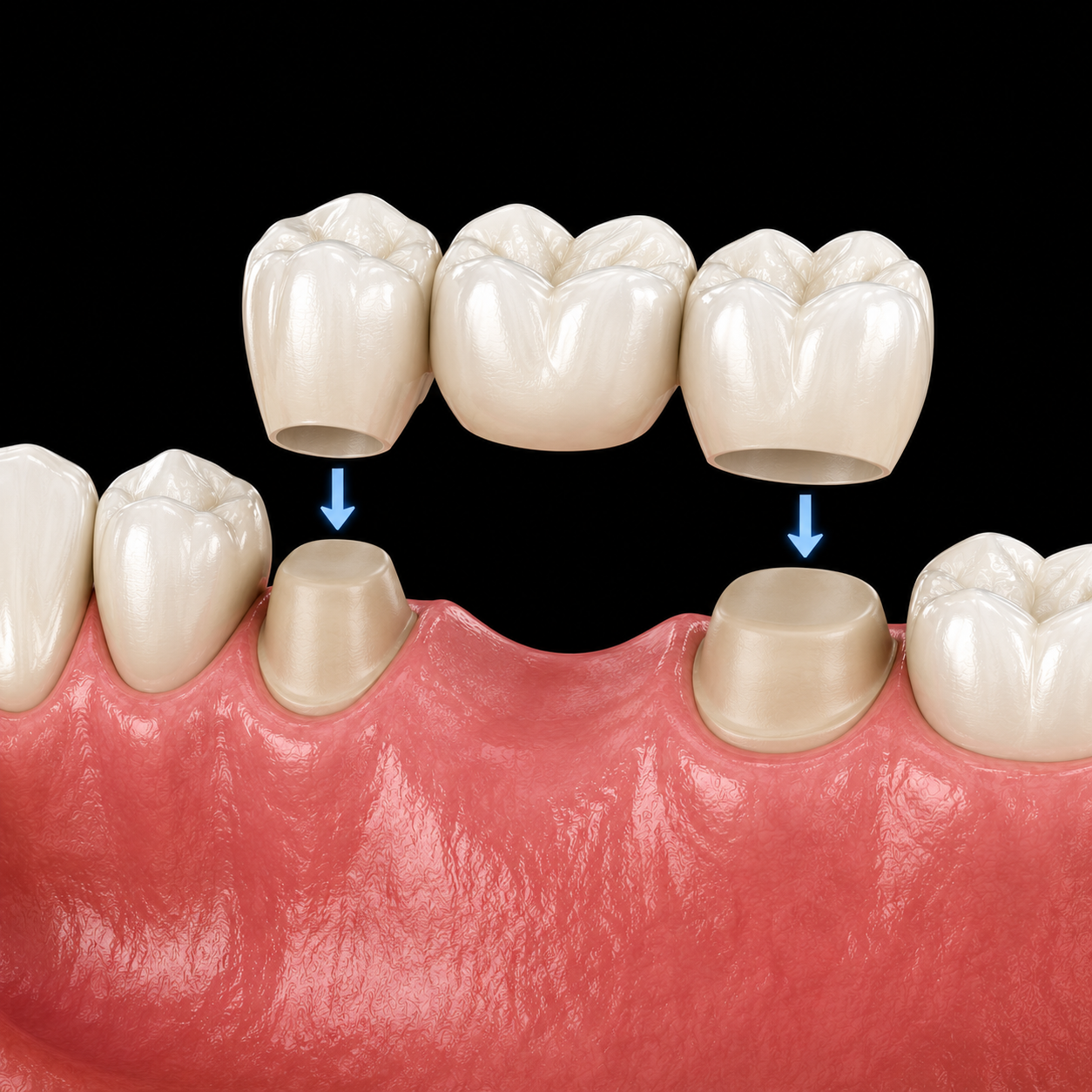 Dental Bridges bridges