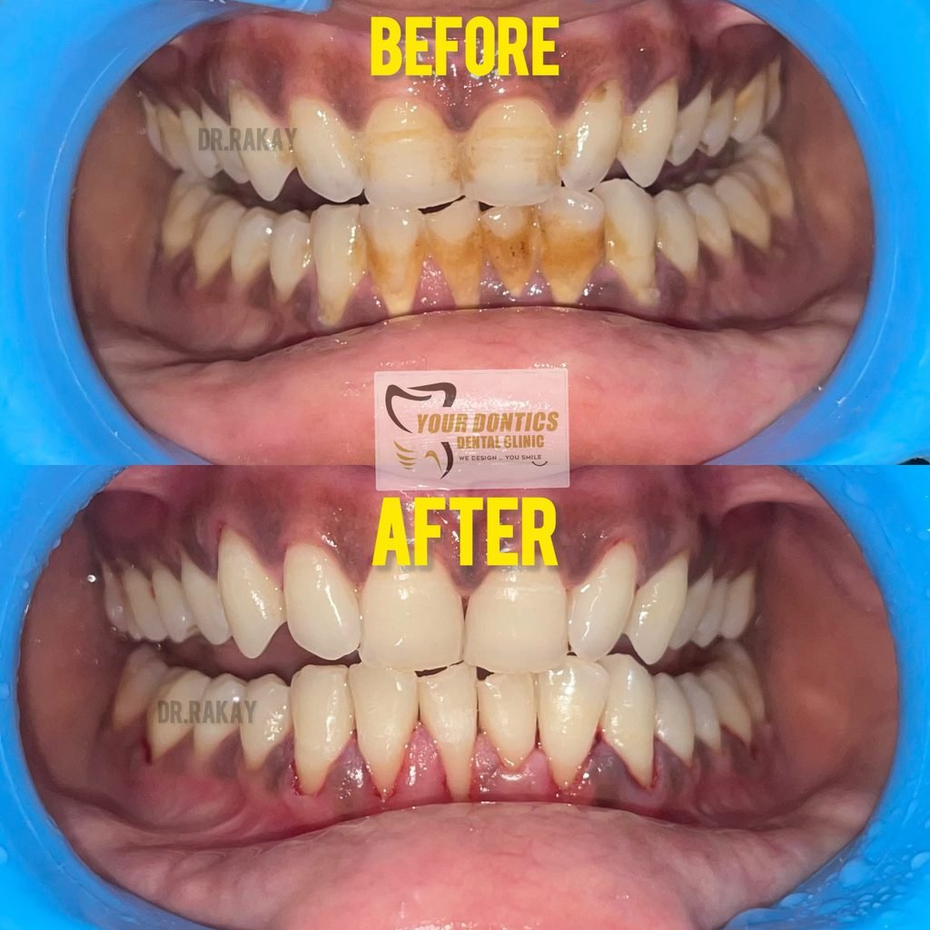 Teeth Cleaning in Kolkata | Teeth Whitening & Scaling – Your Dontics Dental Clinic Professional teeth cleaning and teeth whitening in Kolkata at Your Dontics Dental Clinic, Ballygunge.