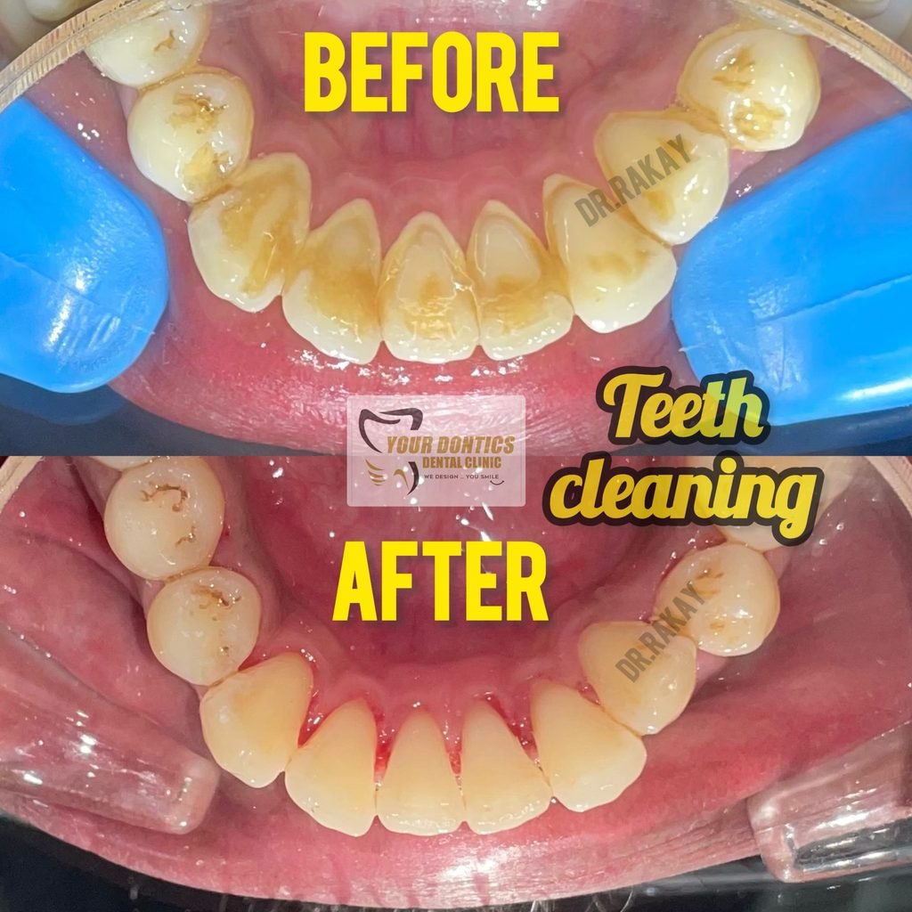 Teeth Cleaning in Kolkata | Teeth Whitening & Scaling – Your Dontics Dental Clinic Professional teeth cleaning and teeth whitening in Kolkata at Your Dontics Dental Clinic, Ballygunge.
