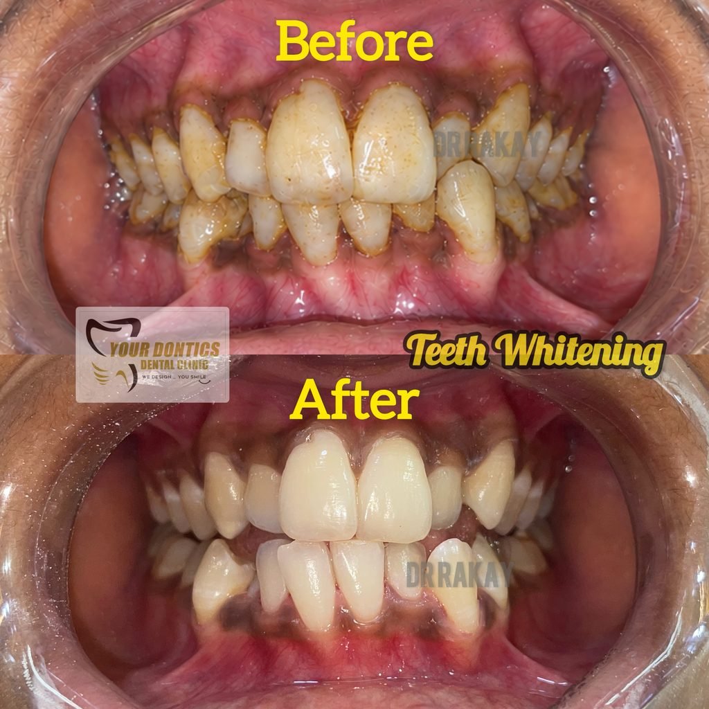 Teeth Cleaning in Kolkata | Teeth Whitening & Scaling – Your Dontics Dental Clinic Professional teeth cleaning and teeth whitening in Kolkata at Your Dontics Dental Clinic, Ballygunge.